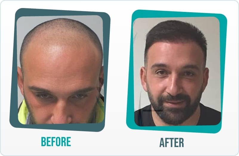 DHI Hair Transplant Choi Implanter Pen Technique